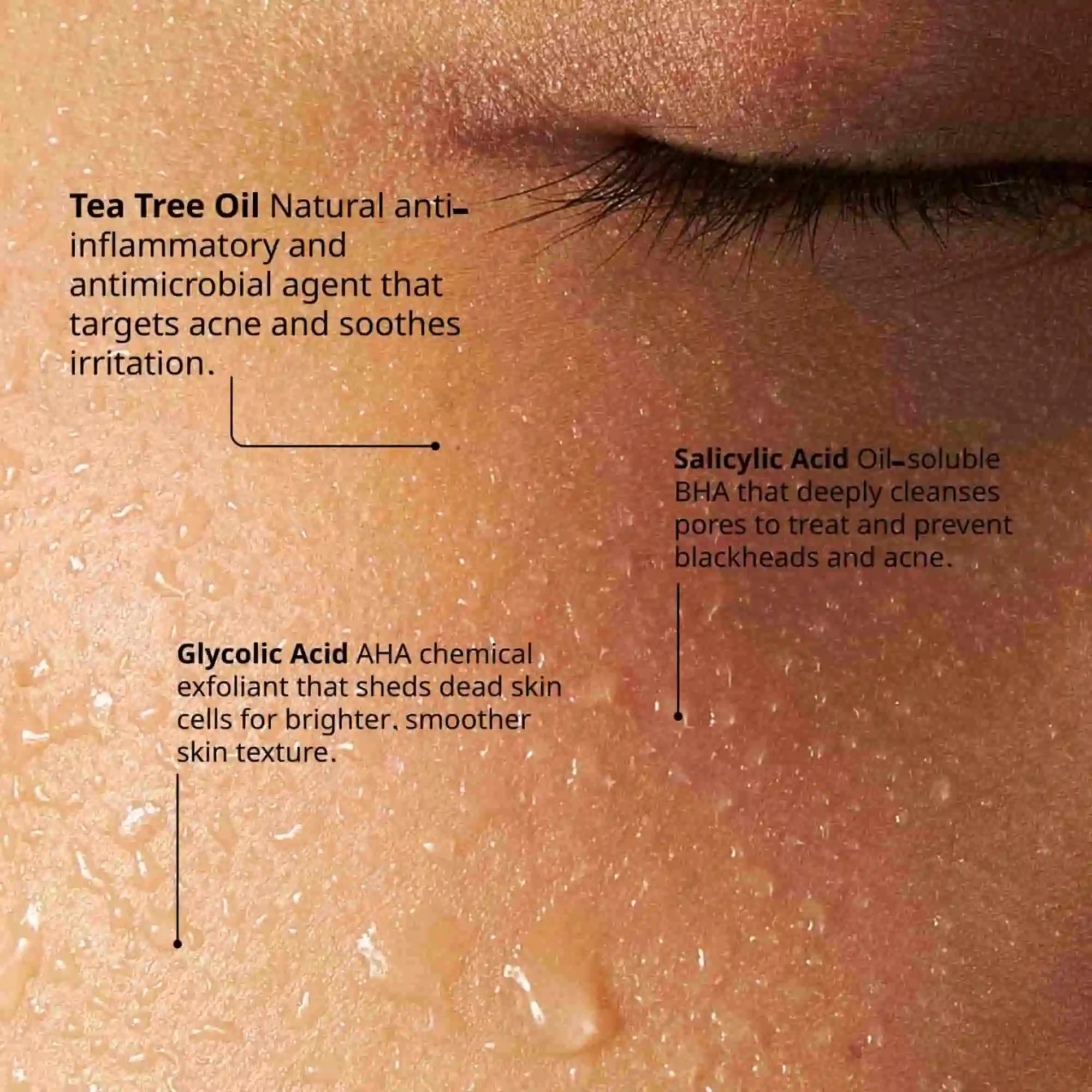 Acne Serum Ingredients, Tea Tree Oil, Salicylic Acid BHA, Glycolic Acid AHA, anti-inflammatory, treat blackheads acne, smoother skin texture